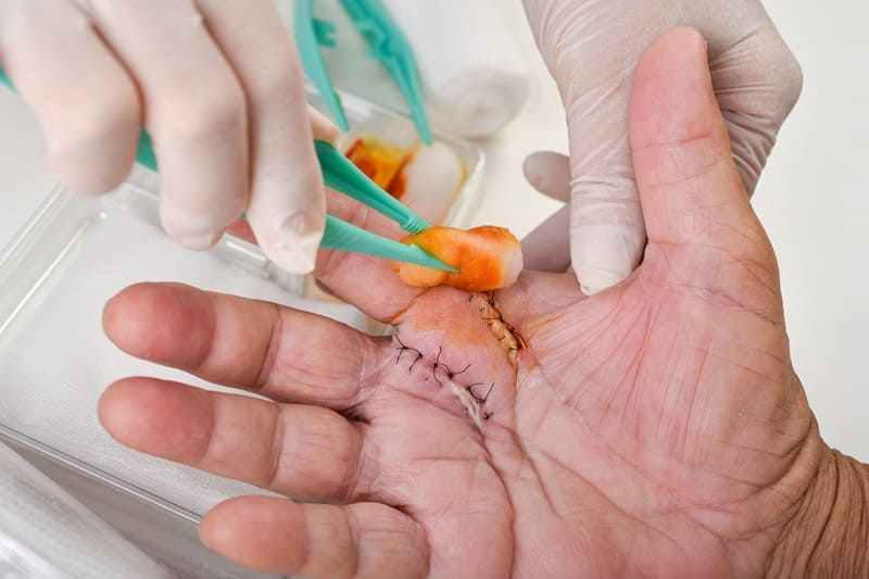 Cirugía de cualquier tumor en piel sospechoso de cáncer de piel en Mérida, Yucatán